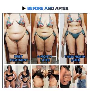 Cryolipolysis Lipolaser Slimming Machine 6D Cellulite Removal Fat Reduction