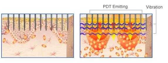 Newest 5 in 1 Derma Vib 540 Needles Derma Roller Dermaroller