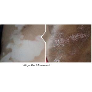 Homeuse 308nm Vitiligo Excimer Laser Targeted Treatment Excimer Light
