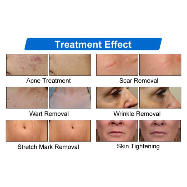 CO2 Fractional Laser Beauty Machine Medical Grade Vaginal Tightening Gynecology Aesthetic Vulva Rejuvenation