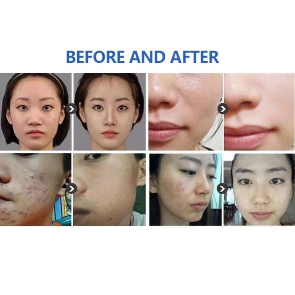 Hydrafacial Treatment 7 In 1 Microdermabrasion Machine Hydro Peel Hydra Dermabrasion Aqua Peel