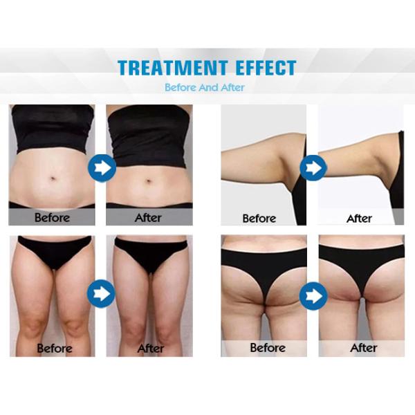 27.12MHz Body Slimming Machine Vibration Cavitation Fat Loss