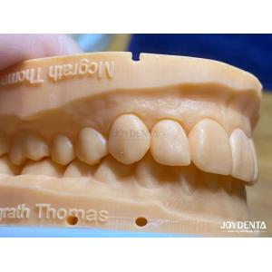 High Permeability Natural Looking Veneers Porcelain Veneers Emax Customized