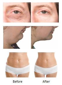 980nm Skin Tightening Laser Machine