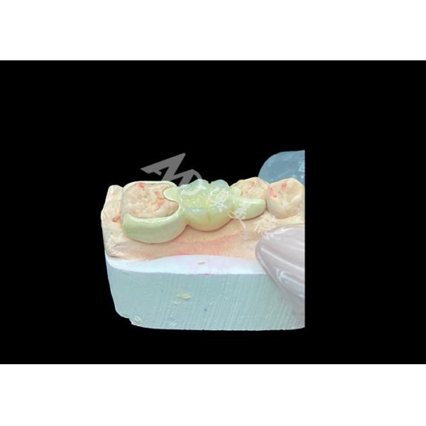 Zirconia Crown with HPP Bonded Bridge for Enhanced Smile Aesthetics and