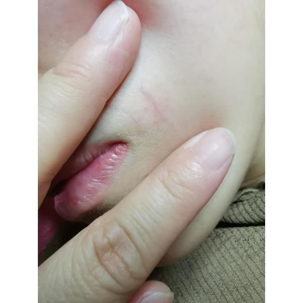 980 Nm Skin Tightening Machine / Diode Laser Vascular Spider Removal Device