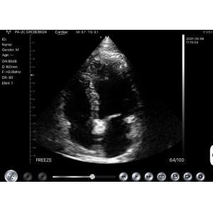 Doppler B Mode Ultrasound Scanner 2.2MHz Wireless Ultrasound Machine
