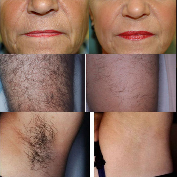 FDA Approved E-light IPL RF Double Handpieces with Monopolar