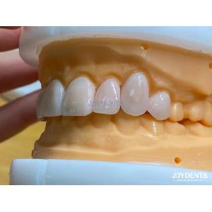 High Permeability Natural Looking Veneers Porcelain Veneers Emax Customized