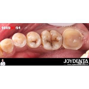 Natural Color Accurate Fit Dental Inlay For Damaged Teeth Restoration