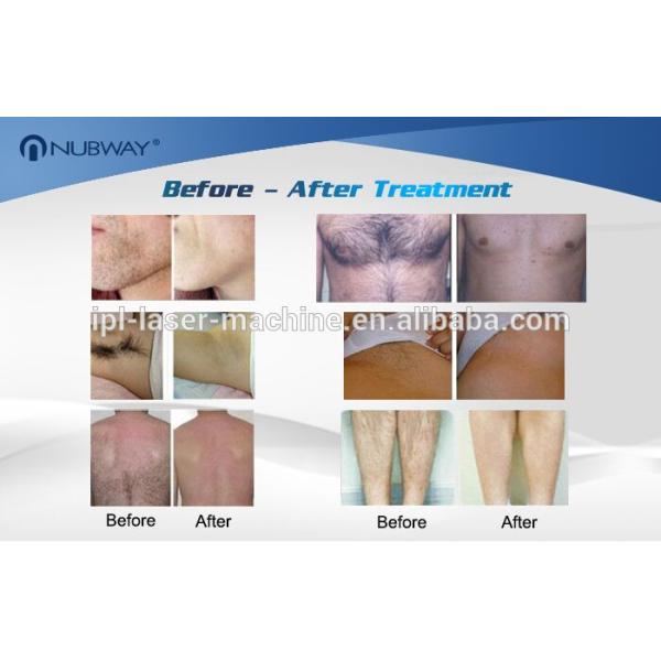 3 years warranty beauty equipment 808nm diode laser lightsheer laser hair removal machine for sale