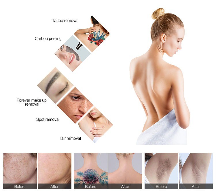 2 In 1 Diode Laser Nd YAG Laser Hair Removal Machine NO Q-Switch