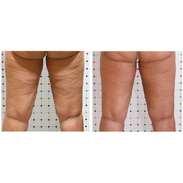 Fat Cells Remove Body Slimming Coolwaves Cellulite Removal Machine