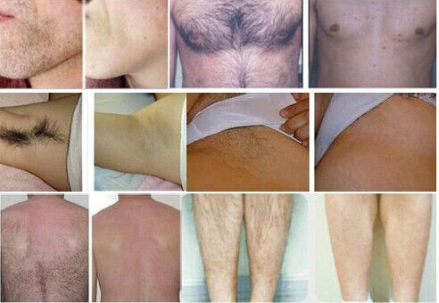 Painless Diode Laser Beauty Salon Hair Removal Axillary Hair Removal Equipment