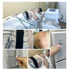 Portable Fat Freezing Machine Slimming Fat Cellulite Removal Cryotherapy Device