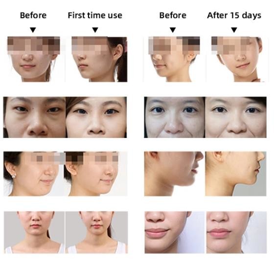 80w Sgs And Ce 2 In 1 Thermolift Vacuum Slimming Machine