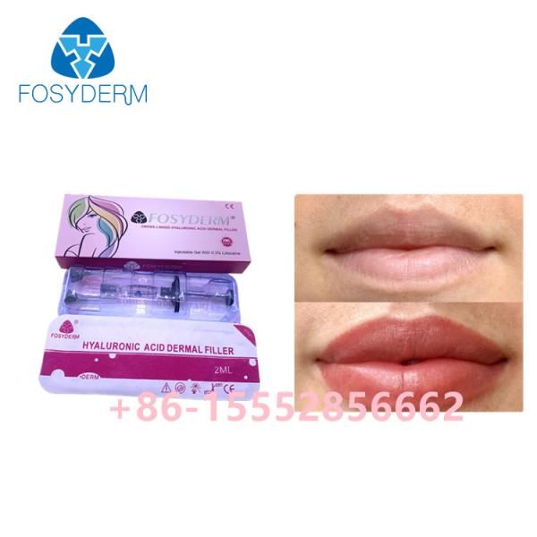 Buy 2ml Fosyderm Dermal Filler Hyaluronic Acid For Lips Enhancement at wholesale prices