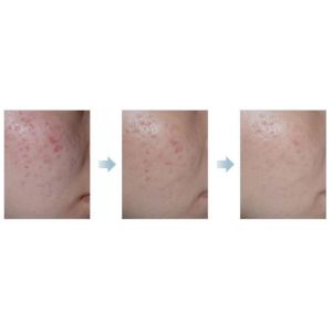 Portable No Needles Mesotharapy needle free beauty equipment machine