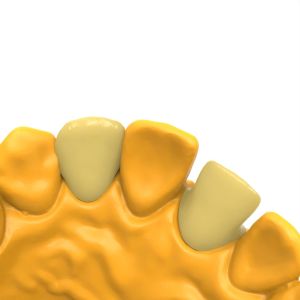 Biocompatible Permanent Crown Bridge Resin Hot Deformation Temperature 80C