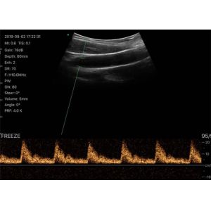 Pocket Handheld Ultrasound Scanner With Wifi Connected To IPad Mobilephone