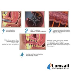 Vaginal Tightening Fractional Co2 Laser Machine 10600nm