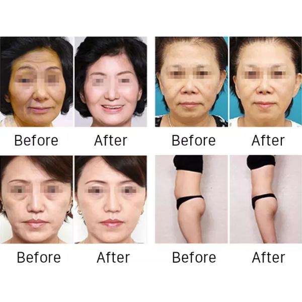 Beauty 3D HIFU Machine Vaginal Tightening Facial Lifting Wrinkle Removal