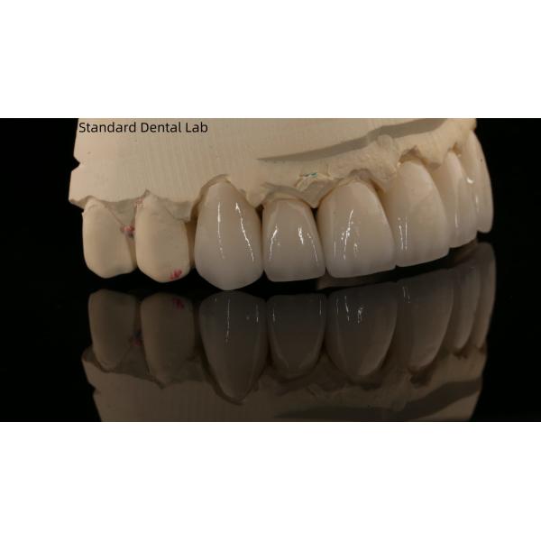 Full Contour Zirconia Crown and High Aesthetic Natural Dental Bridge 5 Year Guarantee