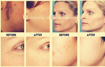 Double Handles Vertical E light IPL Tattoo Removal RF Beauty Device