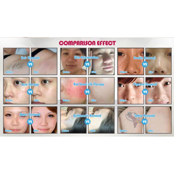 OPT SHR+Elight (IPL&RF)+ND YAG LASER MJ600