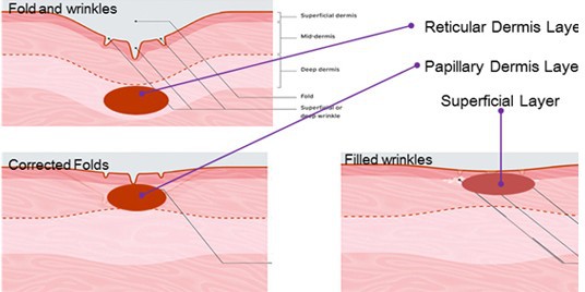 Wellness center Fractional RF Microneedle Acne Scar Removal Beauty Machine