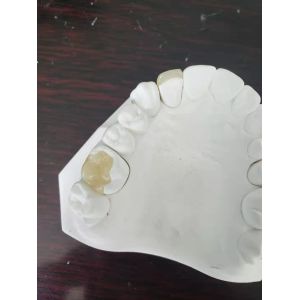 Durable FDA All-Ceramic Dental Crown Veneer Inlay Onlay Similar