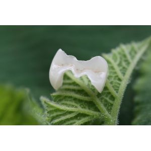 Onlay And Inlay Esthetic Artificial EMAX Dental Crown