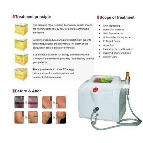 Skin tightening beauty machine fractional rf for face