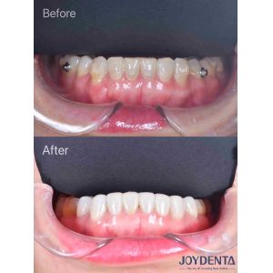 Porcelain Veneer Oral Restoration