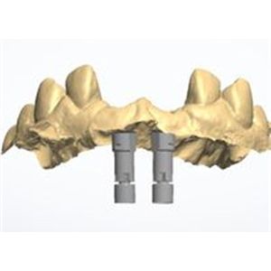 3D model Zirconia crown