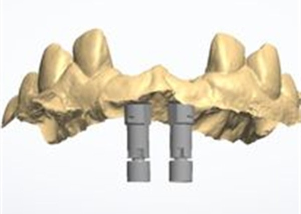 Buy 3D model Zirconia crown at wholesale prices