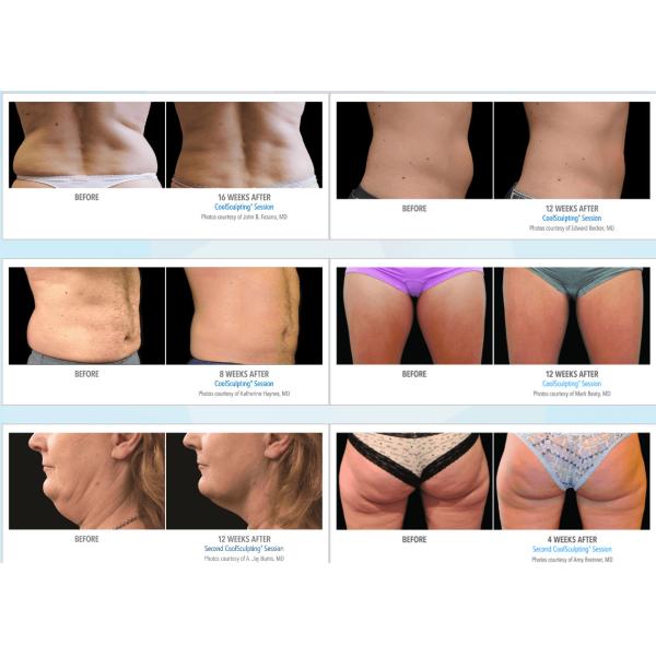 20MHZ RF 100kPa 25m3/H Cavitation Slimming Machine