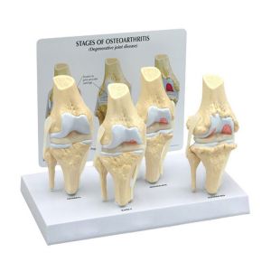 Skeleton Osteoarthritis 7.5x14x6cm Human Knee Model