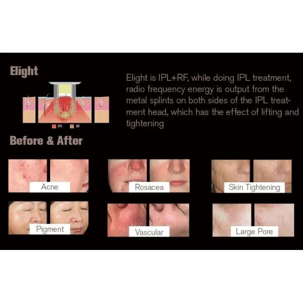 Professional Permanent IPL OPT Epilator Skin Rejuvenation Hair Removal Machine