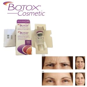 Quality Allergan Injectable For Forehead Wrinkles 100ui for sale