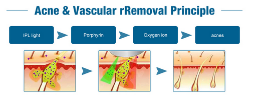 Professional Skin Rejuvenation IPL SHR OPT Hair Removal Machine iMED LaserTell