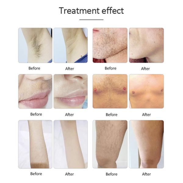 Portable 808nm Diode Laser Hair Removal Machine For Home hair removing laser machine lady hair removal machine