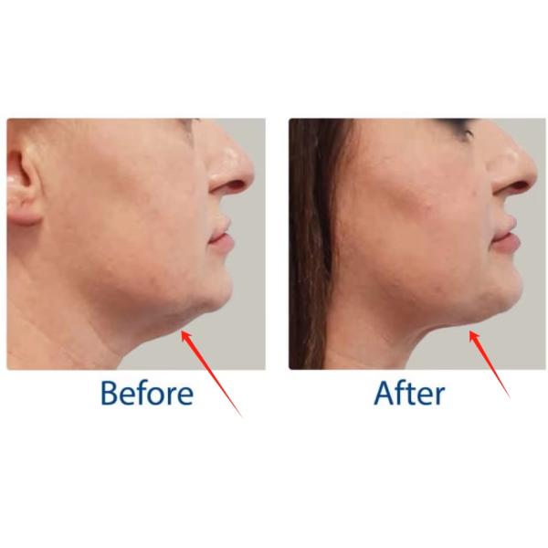 Fat Cells Remove Body Slimming Coolwaves Cellulite Removal Machine