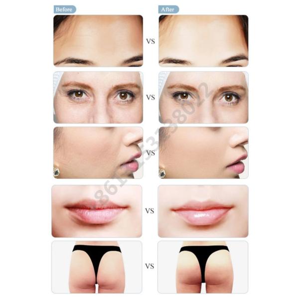 1ml Cross Linked Hyaluronic Acid Dermal Filler Injection Deep For Nose Chin Cheek