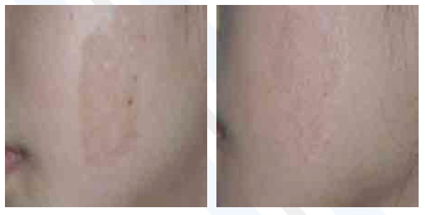 Nd YAG Q Switched Laser For Tattoo Removal / Vascular Lesions Removal Long Pulse
