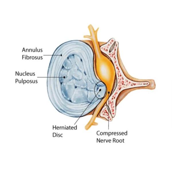 15W 1940nm Medical Diode Laser Treatment Equipment Herniated Intervertebral Disc