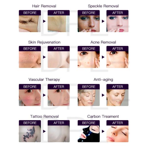 DPL ipl permanent laser lamp flash hair removal rf skin 3 in 1 ice cool new design ipl laser permanent hair removal