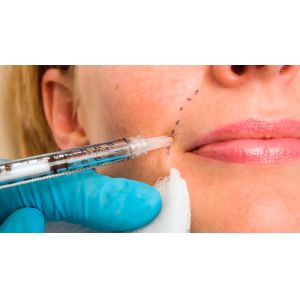 Collagen Stimulating PCL Dermal Filler Gel Hyaluronic Acid with CMC Anti Wrinkle