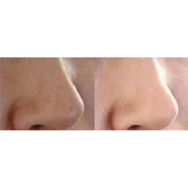 Ultrasound skin scrubber Serum and water peeling hydro skin facial with Hydradermabrasion