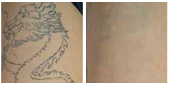 Skin Care Pigmentation Removal Machine With Monaliza Q Switched Nd Yag Laser